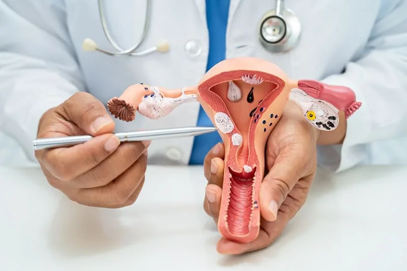 Tratamiento Integral de la Endometriosis